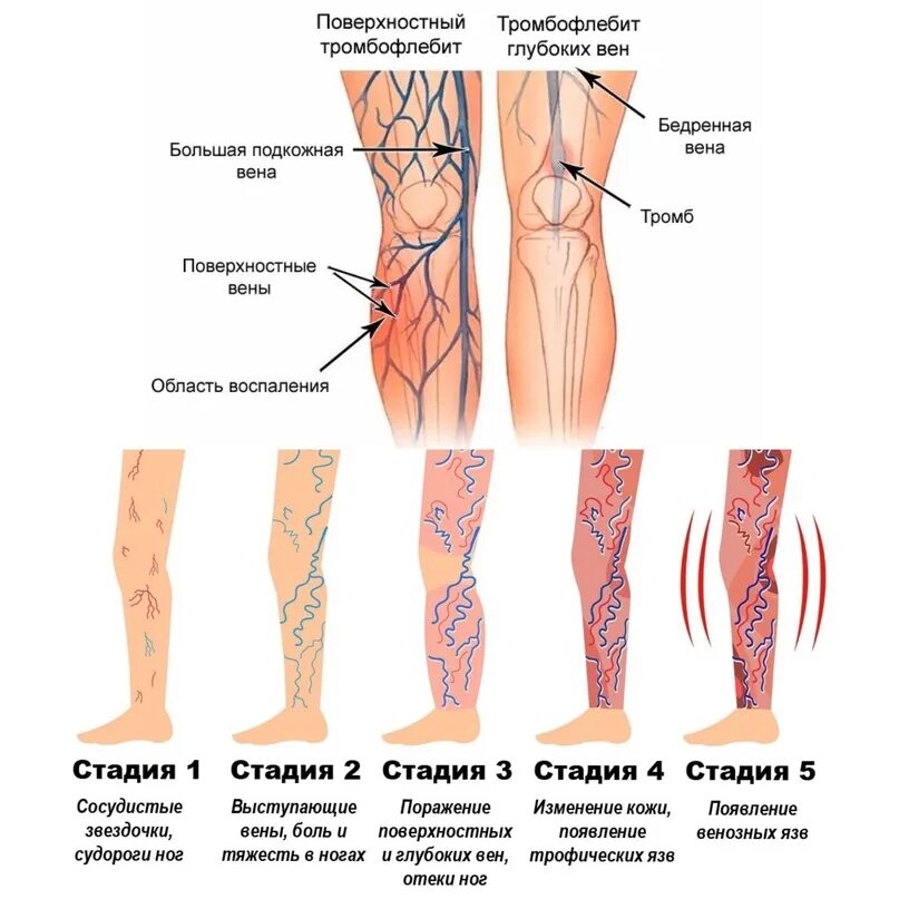 Поверхностный тромбофлебит нижних конечностей фото Тромбоз суральных вен