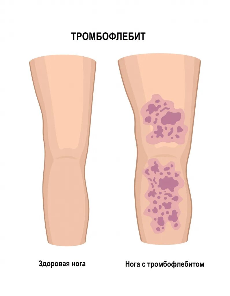 Поверхностный тромбофлебит нижних конечностей фото Тромбофлебит - причины появления, симптомы заболевания, диагностика и способы ле