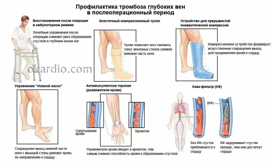 Поверхностный тромбофлебит нижних конечностей фото Картинки ТРОМБОФЛЕБИТ НИЖНИХ КОНЕЧНОСТЕЙ ЛЕЧЕНИЕ МАЗИ