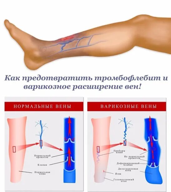 Поверхностный тромбофлебит нижних конечностей фото как предупредить тромбофлебит и варикозное расширение вен Татьяна Гаджимамаева Ф