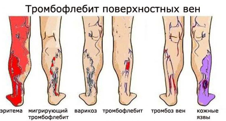 Поверхностный тромбофлебит нижних конечностей фото Лечение тромбофлебита поверхностных вен в Москве: цены, фото до и после, отзывы 