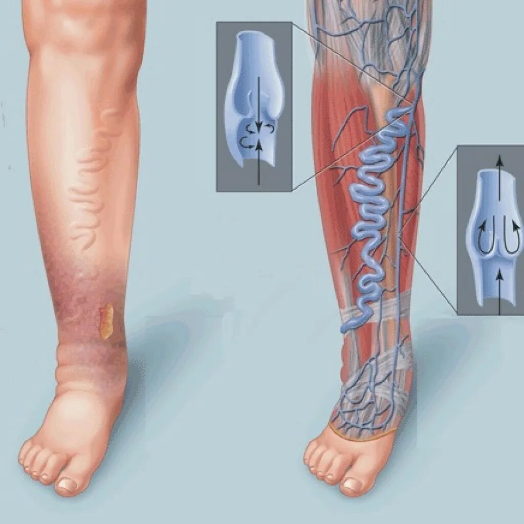 Поверхностный тромбофлебит нижних конечностей фото Тромбофлебит: симптомы, причины, лечение Диагностика и уход за венами