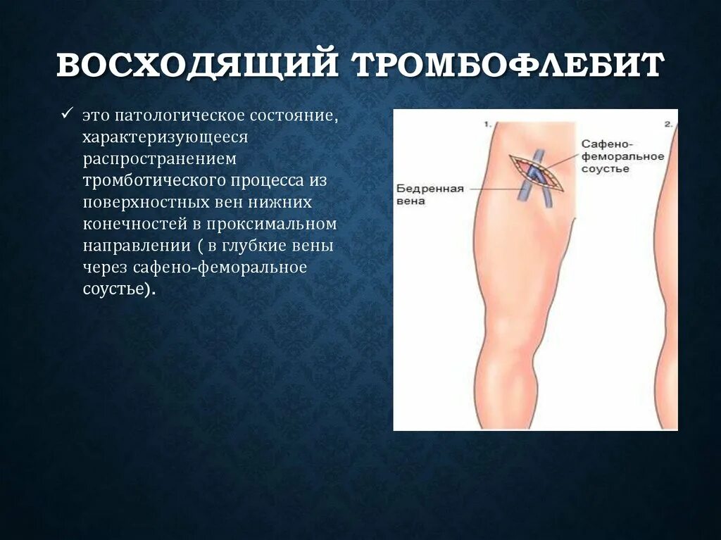 Поверхностный тромбофлебит нижних конечностей фото Картинки ТРОМБОЗ ХАРАКТЕРИСТИКА