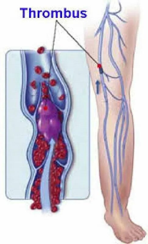 Поверхностный тромбофлебит нижних конечностей фото Флеботромбоз вен
