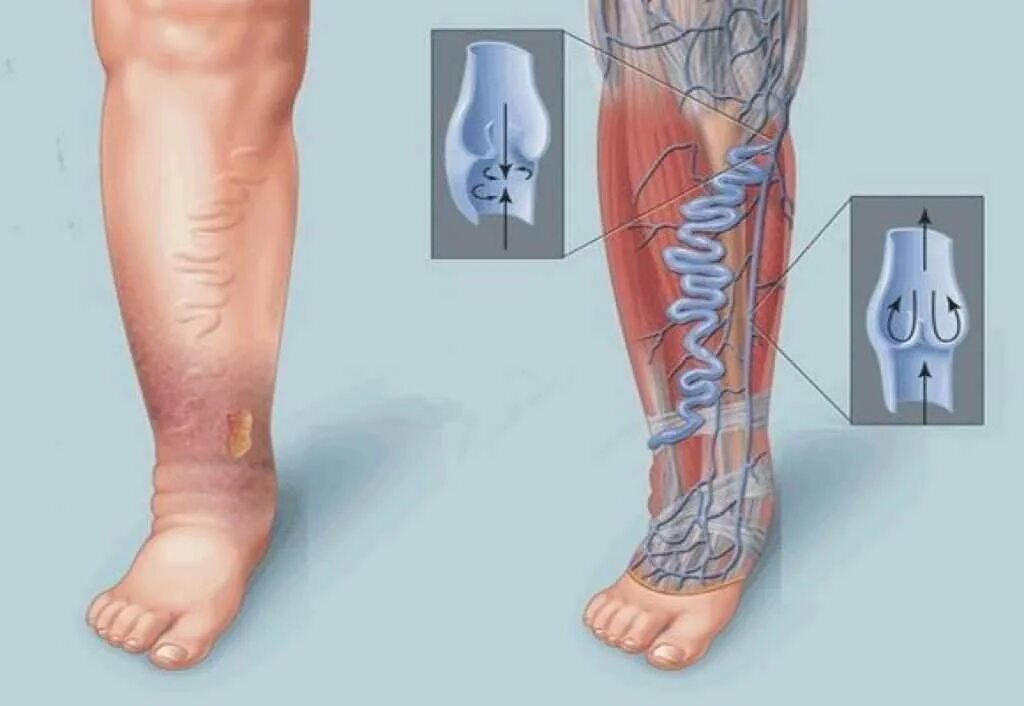 Поверхностный тромбофлебит нижних конечностей фото Тромбоз глубоких вен нижних конечностей: симптомы и лечение