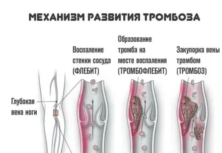 Поверхностный тромбофлебит нижних конечностей фото Risk factors for thrombosis. Most of the risk factors for venous and arterial th