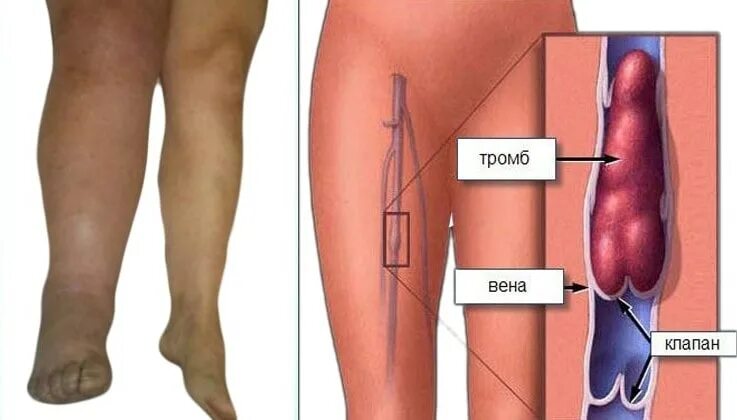 Поверхностный тромбофлебит нижних конечностей фото Илеофеморальный тромбоз: симптомы, диагностика, лечение "Институт Вен"