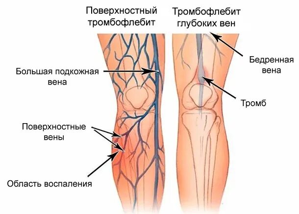 Поверхностный тромбофлебит нижних конечностей фото Тромбофлебит: симптомы, лечение, диагностика в ФНКЦ ФМБА России