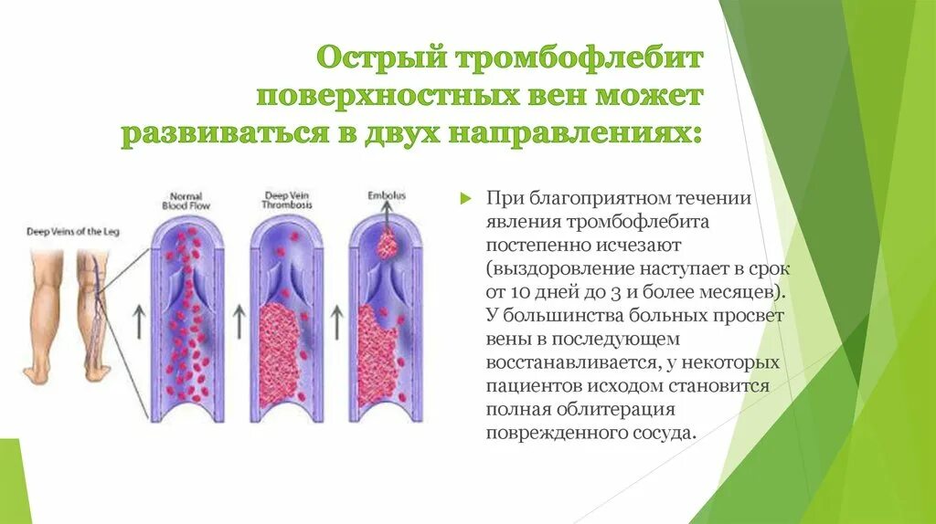 Поверхностный тромбофлебит нижних конечностей фото Классификация и клиническая картина тромбофлебита - online presentation