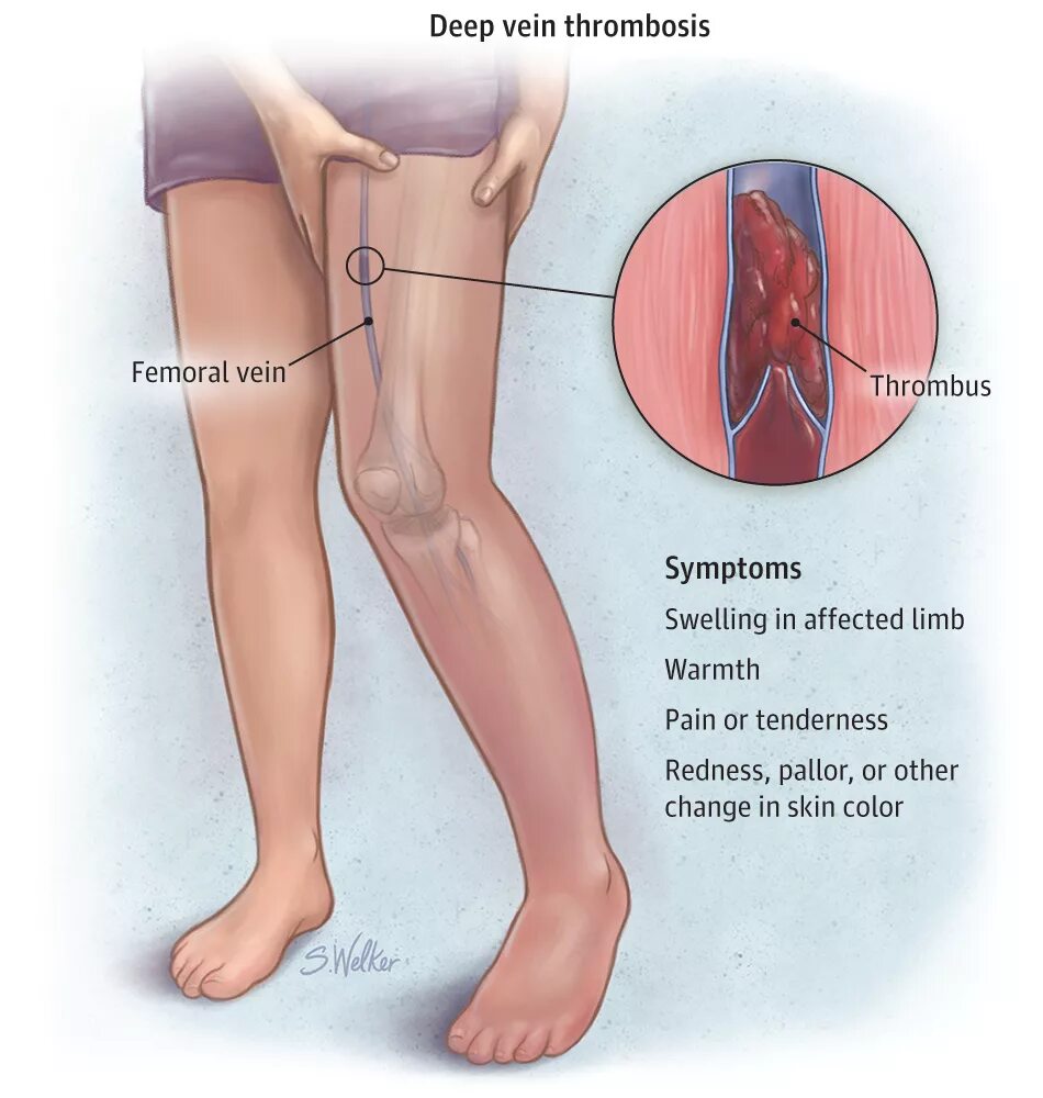 Поверхностный тромбофлебит нижних конечностей симптомы фото Blod Clot In Leg Symptoms Clearance poligraf-ti.kz