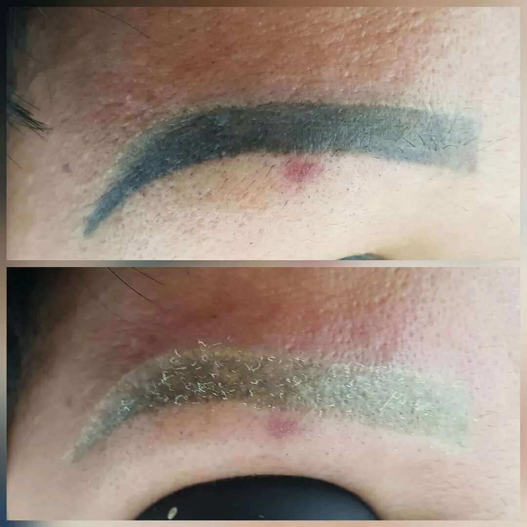 Повторный татуаж Удаление татуажа метро Лукьяновская, Киев - цена, отзывы на Barb.ua