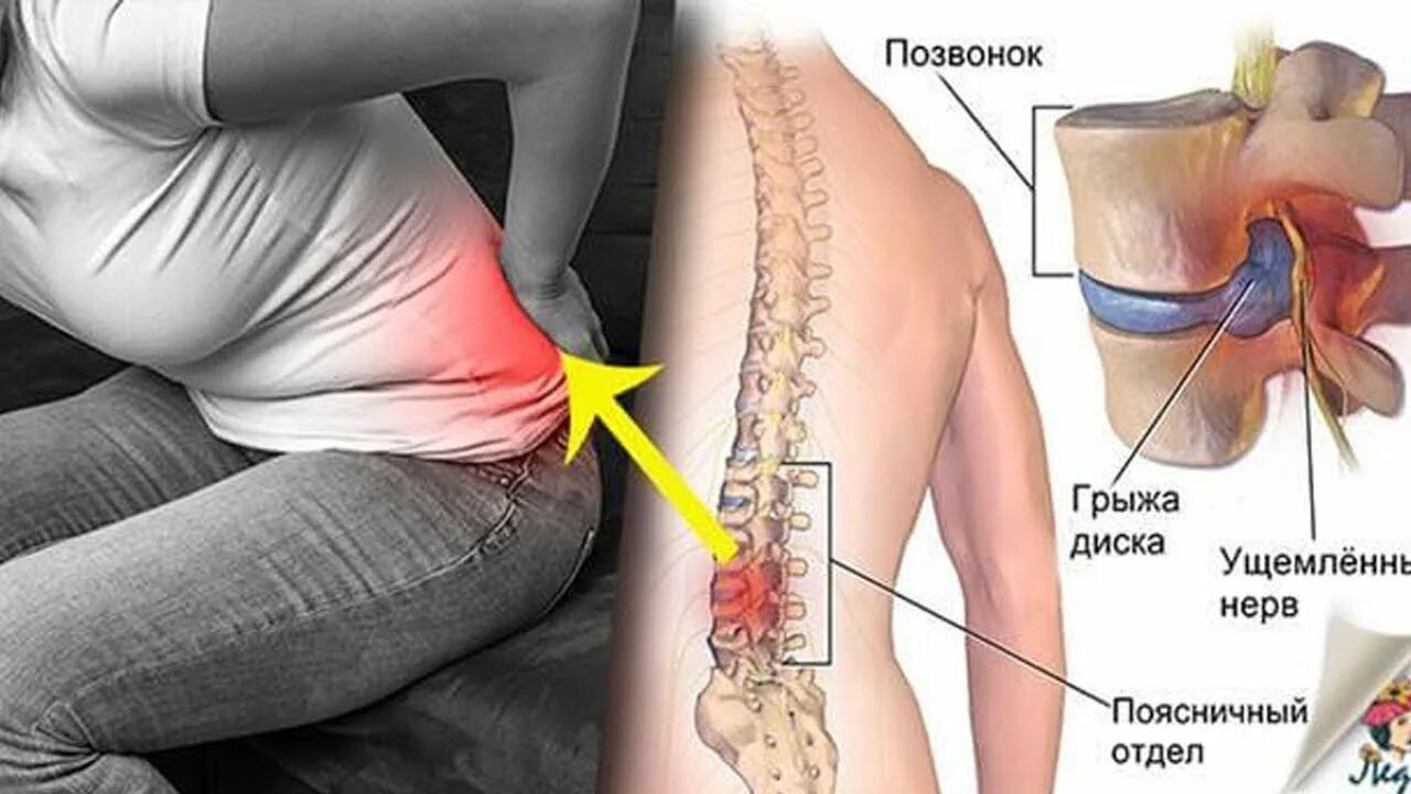 Поясничная грыжа симптомы и лечение фото Как болит межпозвонковая грыжа диска позвоночника