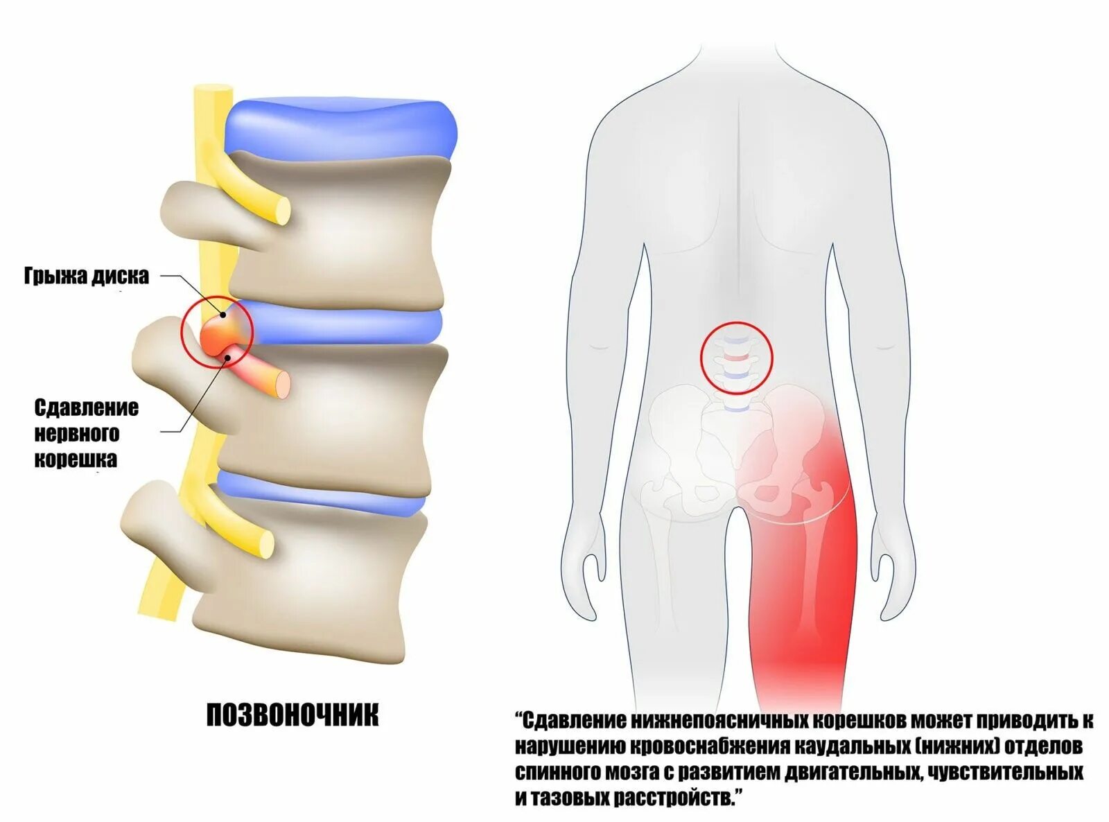 Поясничная грыжа симптомы у мужчин фото Симптомы грыжи позвоночника - Клиника Вертеброневрологии