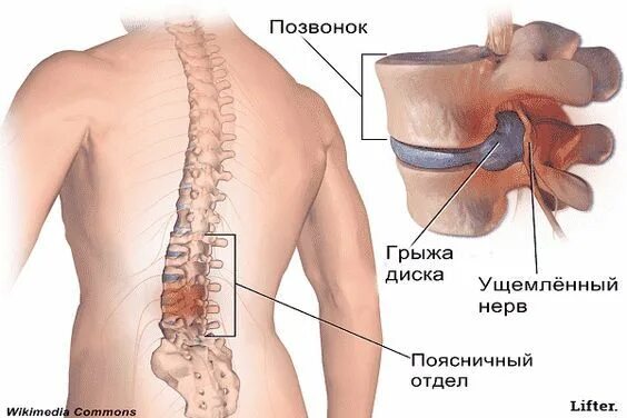 Поясничная грыжа симптомы у мужчин фото Пин на доске фигура