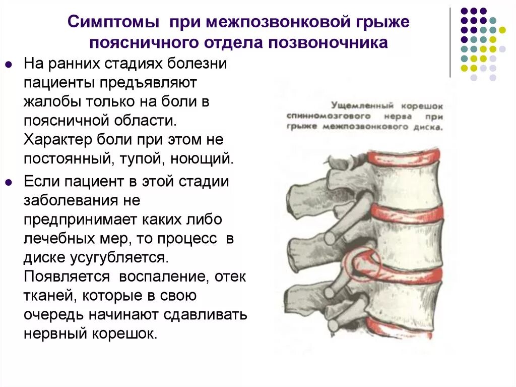 Поясничная грыжа симптомы у мужчин фото Грыжа поясничного отдела к какому врачу обращаться - найдено 80 картинок