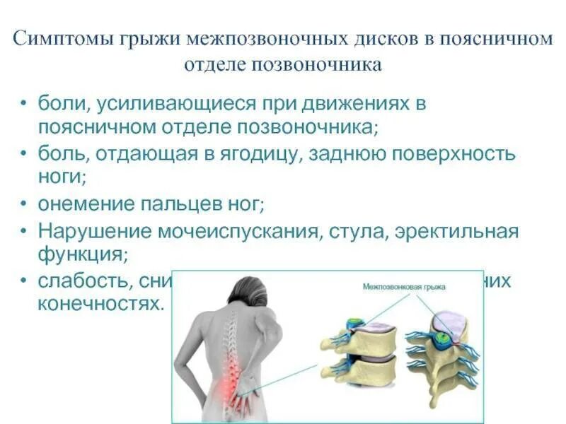 Поясничная грыжа симптомы у мужчин фото Межпозвоночная грыжа поясничного отдела - Здоровье - Вопросы и ответы про йогу