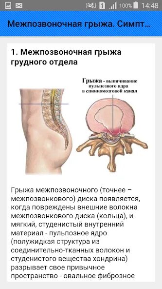 Поясничная грыжа симптомы у мужчин фото Межпозвоночная грыжа. Симптомы - אפליקציות ב-Google Play