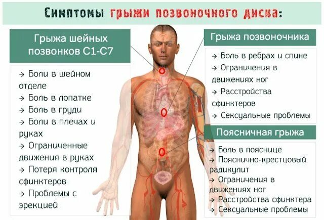 Поясничная грыжа симптомы у мужчин фото Шейная грыжа у мужчин - не приговор МЦ Гармония