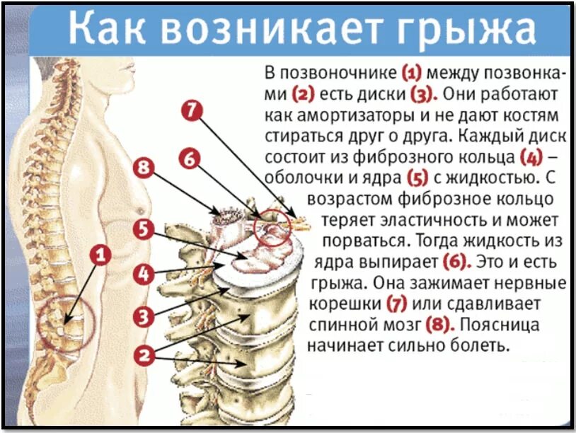 Поясничная грыжа симптомы у мужчин фото МРТ при обследовании позвоночника " КрасМедЦентр