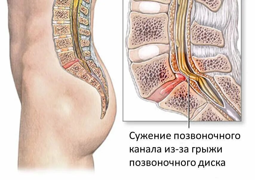 Поясничная грыжа симптомы у женщин фото Грыжа поясничного отдела правильное лечение. Врач Мануальный Терапевт Спб Дзен