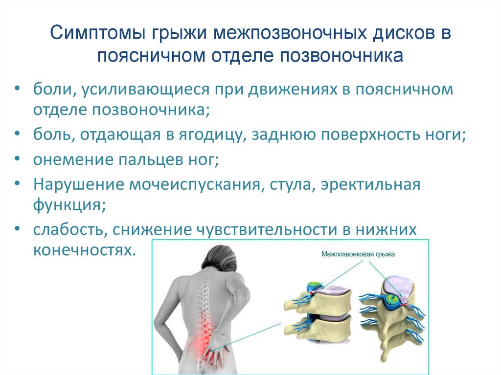 Поясничная грыжа симптомы у женщин фото Грыжа межпозвоночных дисков - презентация онлайн