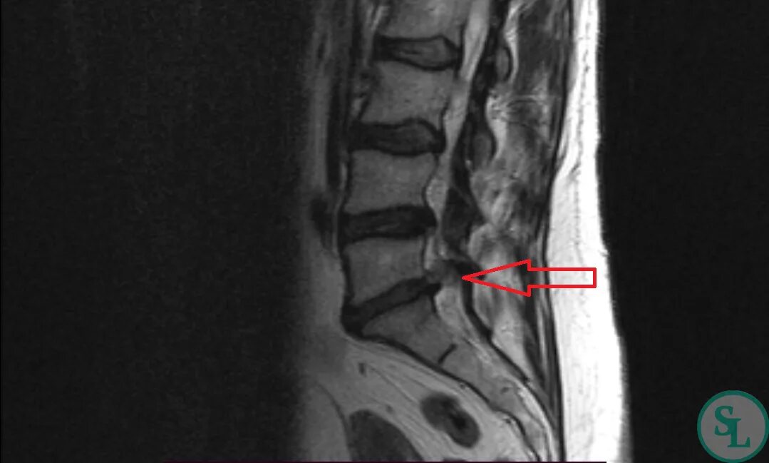 Поясничная грыжа симптомы у женщин фото Поясничная грыжа примеры работ и операций SL Клиника - лечение заболеваний позво