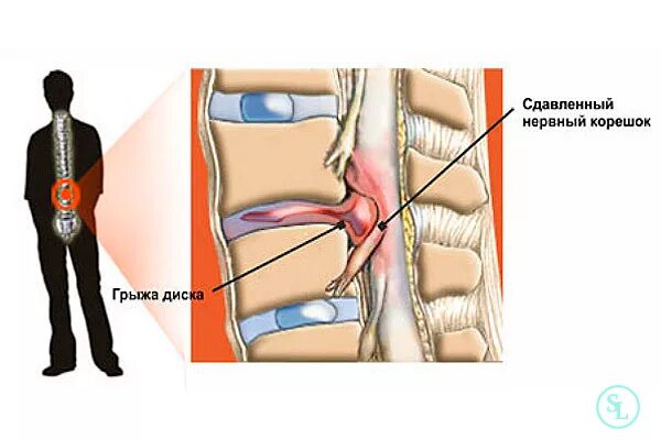 Поясничная грыжа симптомы у женщин фото Грыжа межпозвоночного диска, операция по удалению в Москве, стоимость и цены