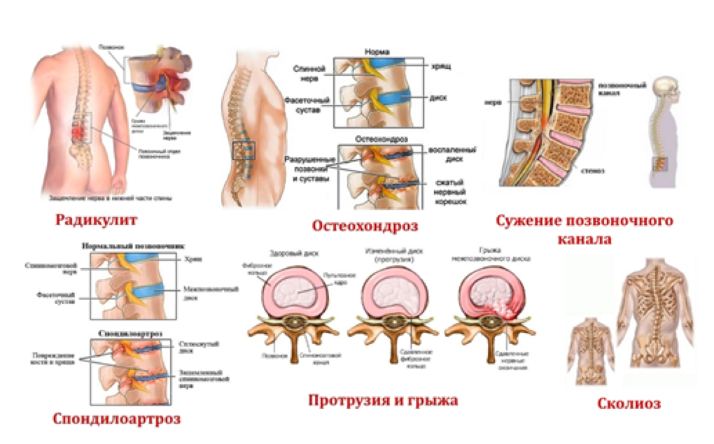 Картинки ГРЫЖА В КРЕСТЦОВОМ ОТДЕЛЕ ПОЗВОНОЧНИКА