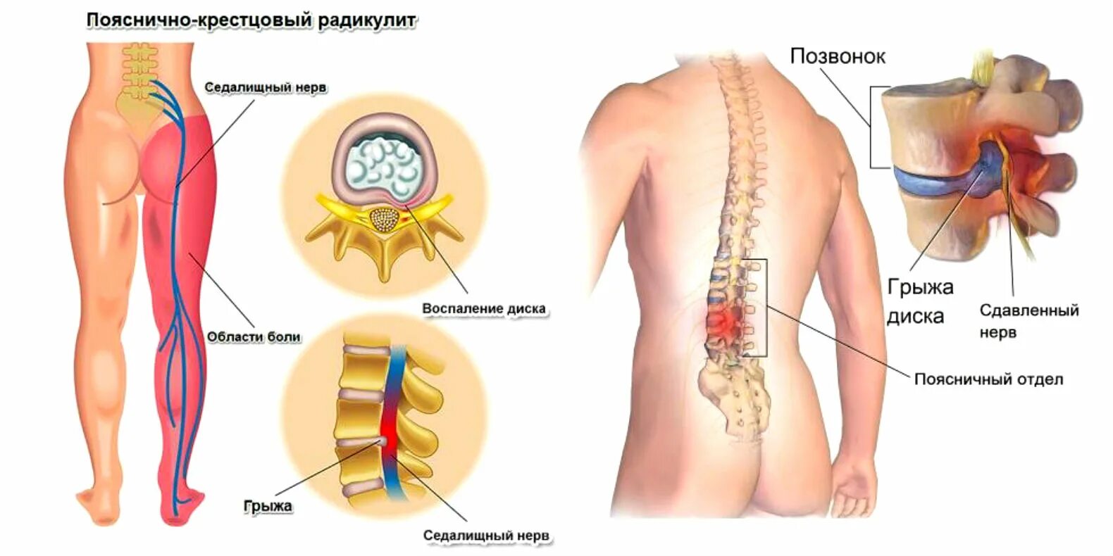 Поясничная грыжа симптомы у женщин фото Первая помощь при пояснично-крестцовых болях - yogavecplaisir.com