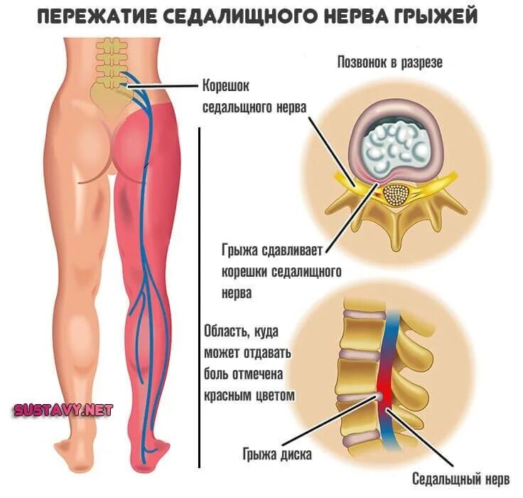 Поясничная грыжа симптомы у женщин фото Защемление седалищного нерва, его симптомы и лечение.