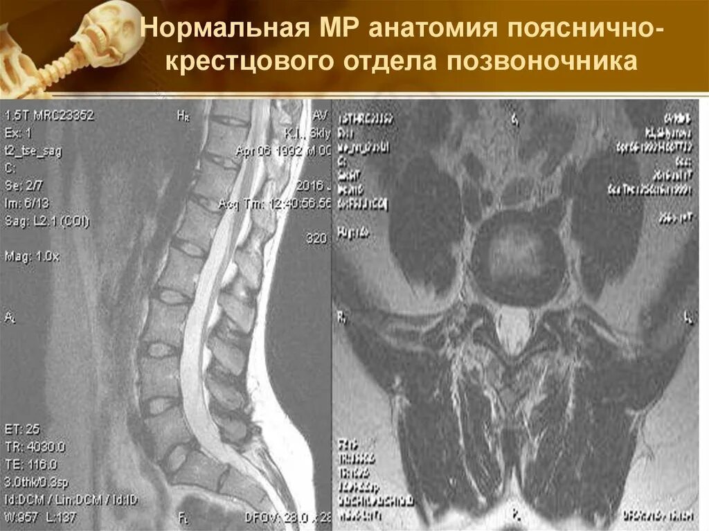 Пояснично крестцовый отдел позвоночника фото Интересные случаи в МРТ - презентация онлайн