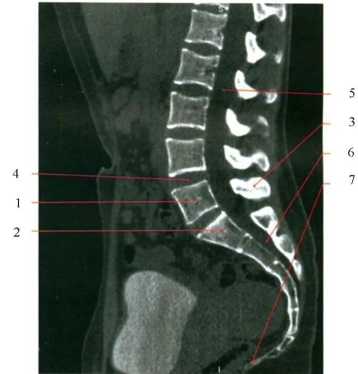 Пояснично крестцовый отдел позвоночника фото Компьютерная томография, современные мультиспиральные компьютерные томографы, мр