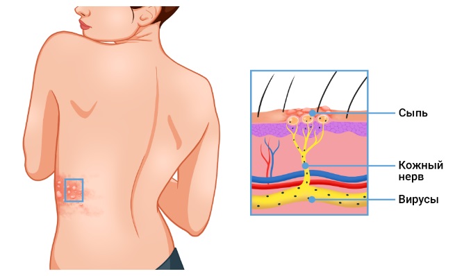 Поясничный герпес фото Опоясывающий герпес (опоясывающий лишай): причины, лечение заболевания