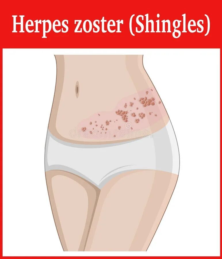 Поясничный герпес фото и лечение у мужчин Illustration of Herpes Zoster Stock Vector - Illustration of infection, paunch: 