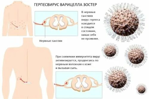 Поясничный герпес фото и лечение у мужчин Поясничный герпес: причины, лечение и последствия