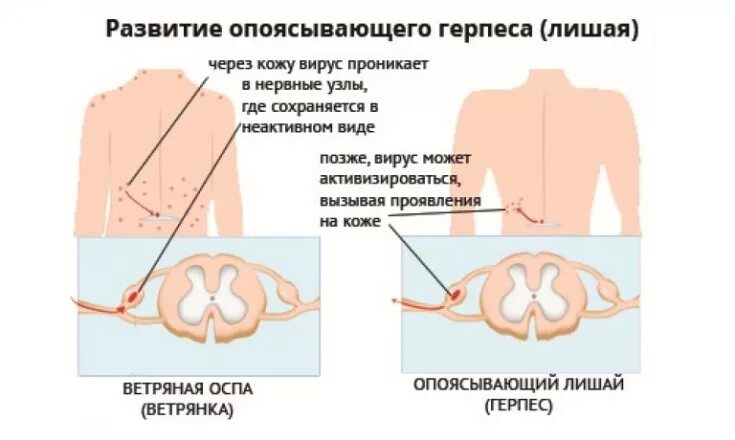 Поясничный герпес фото и лечение у мужчин Клиническая картина и современные подходы к лечению опоясывающего герпеса - Este