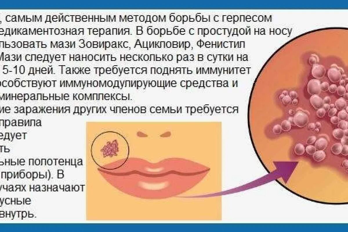 Поясничный герпес отчего появляется как лечить фото Герпес у грудного ребенка: симптомы и лечение