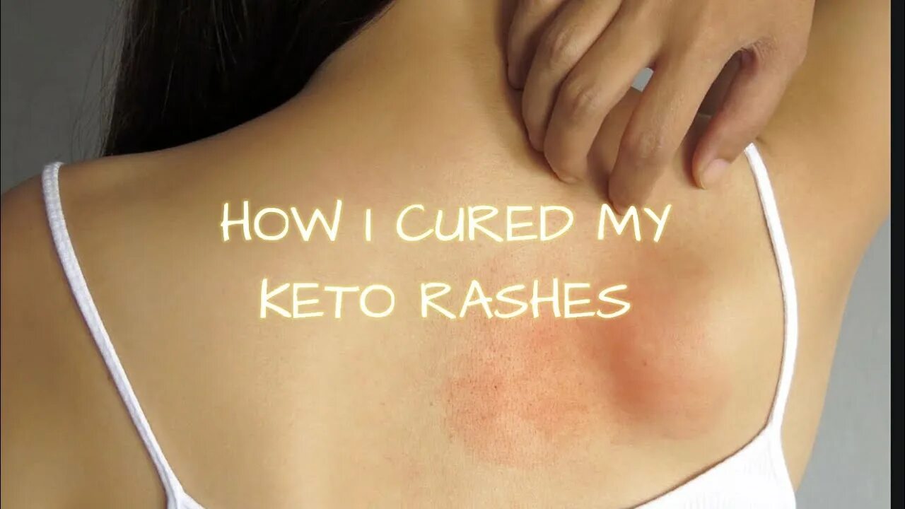 Поясничный лишай фото WHAT I DID TO CURE MY KETO RASH - YouTube