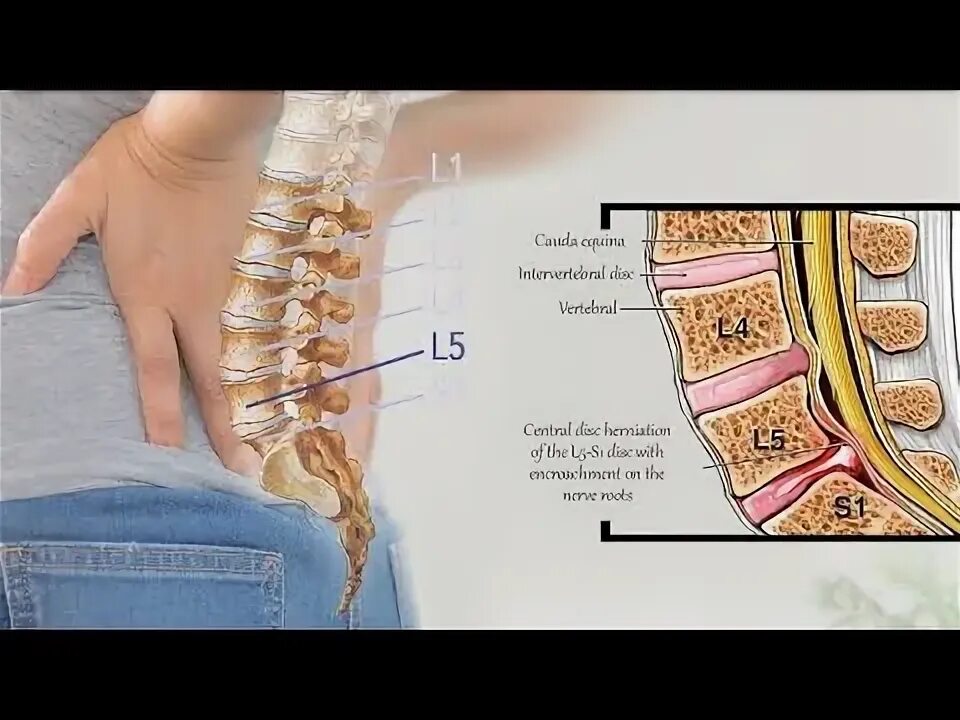 Поясничный отдел человека фото Patient got emotional after Chiropractic treatment for his disc bulge of L5-S1 a