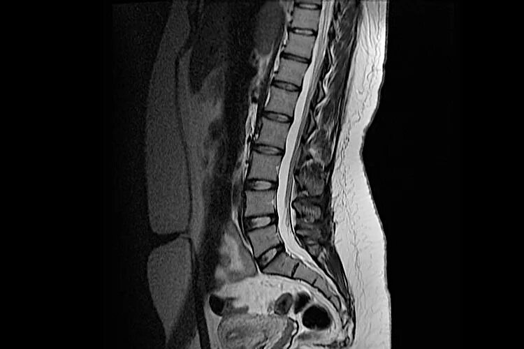 Поясничный отдел позвоночника фото МРТ пояснично-крестцового отдела позвоночника в центре МРТ "Ами" в Санкт-Петербу
