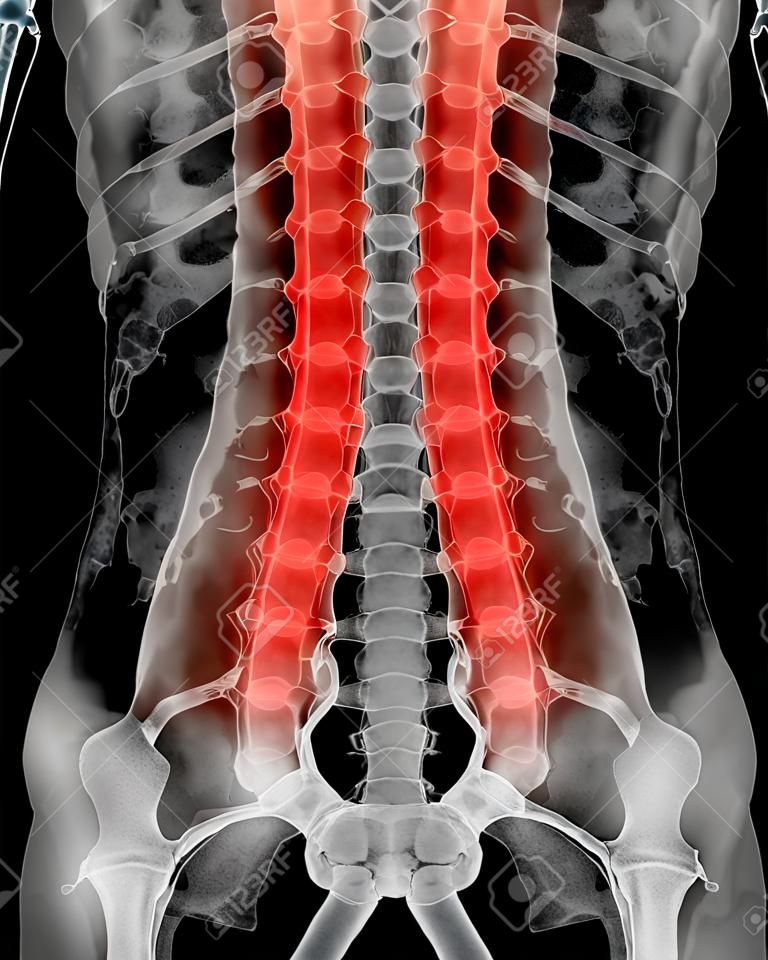 Поясничный отдел позвоночника фото на человеке Lendenwirbelsäule Von Frau Und Entzündung An Der Lendenwirbelsäule (Rückenschmer