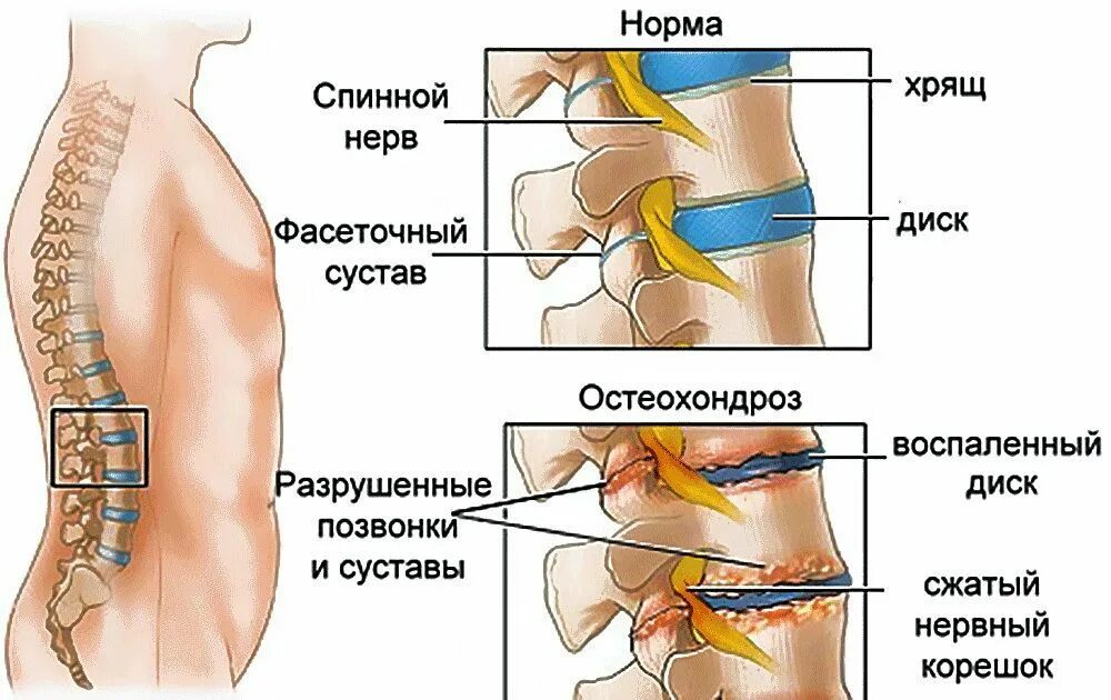 Поясничный отдел позвоночника фото на человеке Неудачные попытки забеременеть и родить: патология позвоночника, диагностика и л