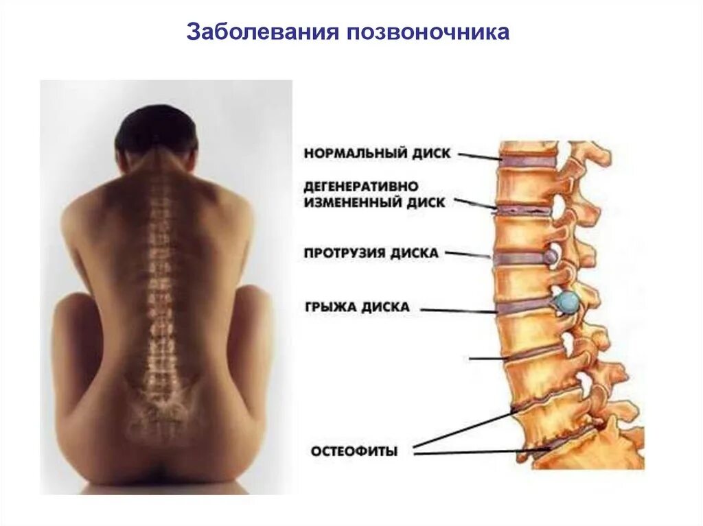 Поясничный отдел спины фото Позвоночник форум пациентов: найдено 84 картинок