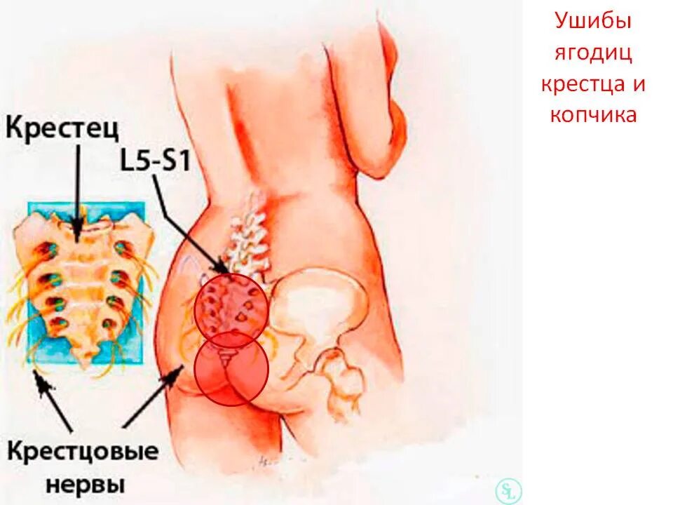 Поясничный отдел женщин фото У меня часто бывает боль в крестце: почему это происходит и можно ли вылечить до