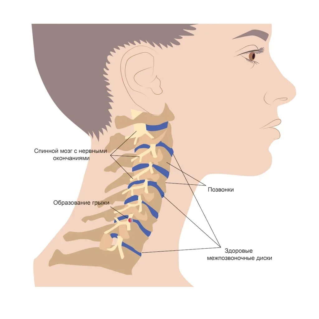 Позвонки шейного отдела позвоночника фото Грыжа диска C4