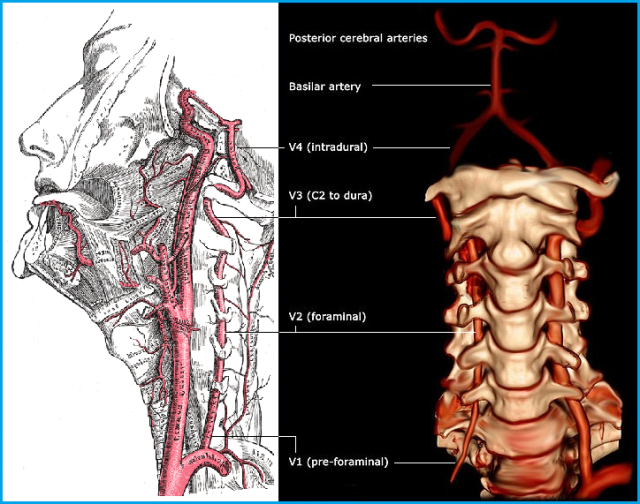 Позвоночная артерия анатомия схема расположения Допплерографические паттерны ВБН (вертебрально-базилярной недостаточности) - Нев
