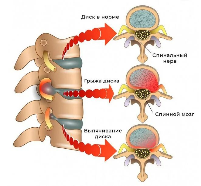Позвоночная грыжа поясничного отдела симптомы фото Безоперационное лечение грыжи позвоночника - Клиника доктора Есиповой