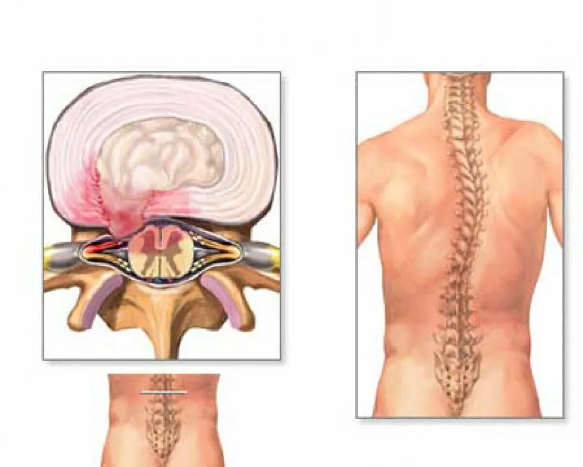 Позвоночная грыжа поясничного отдела симптомы фото Поясничная грыжа Многопрофильная клиника в Санкт-Петербурге ГлавМедЦентр Дзен