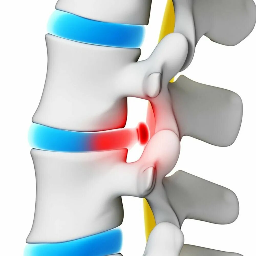 Позвоночная грыжа поясничного отдела симптомы фото Эпизод 9. Больной позвоночник-не приговор! слушать онлайн на Яндекс Музыке