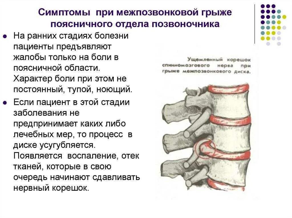 Позвоночная грыжа поясничного отдела симптомы фото Блокада крестцового отдела позвоночника отзывы